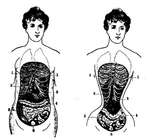 corset deformity.jpg